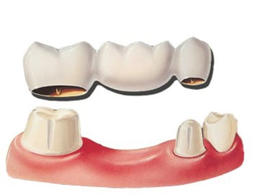 Diagram of a dental bridge for a missing lower molar tooth. The bridge in the diagram is suspended above the two prepared teeth on either side of the missing one; for information on dental implants vs bridge from Dr. Becker of Hoffman Estates.