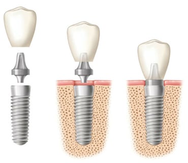 Diagram of a three dental implants: Left: Three components of the dental implant, including the root form, abutment, and the crown (hovering on top); 2: The root form in the bone with the abutment and crown hovering over it; 3: All components of the implant are in place with the root form in the bone.