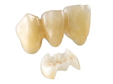 Photo of two types of e.max restorations: On the top is a series of three crowns for a dental bridge, and on the bottom is a porcelain overlay.