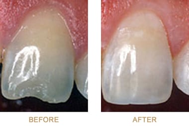 Before and after photos of dental bonding, which is available to repair cracked or chipped teeth, from Poplar Crossing Dental in Hoffman Estates, IL.