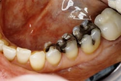 Side-view before photo of lower left teeth, including the premolars and one molar tooth that have old amalgam fillings, for information on metal-free dentistry from Hoffman Estates dentist Dr. Becker.