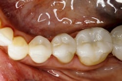 Side-view after photo of lower left teeth, including the premolars and one molar tooth that had old amalgam fillings with porcelain onlays, for information on metal-free dentistry from Hoffman Estates dentist Dr. Becker.