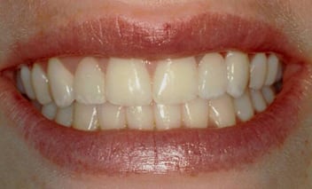 After close-up photo of a woman's mouth. She is smiling to show her dental bridge, made of porcelain crowns, which replaced her upper lateral incisors.