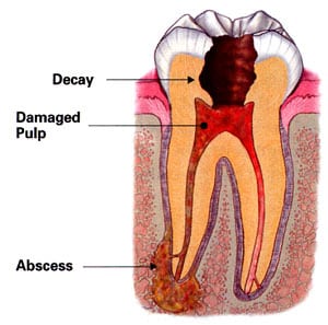 Diagram of the inside of a tooth from the top to its roots. Pictured inside the tooth and labeled are 1) decay at the crown, 2) red damaged pulp, and 3) an abscess at the tooth root.