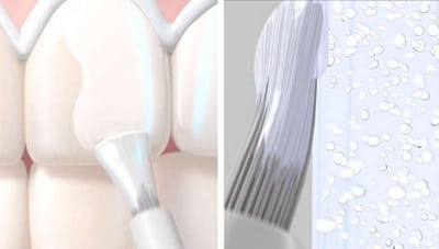 Image of Zoom QuickPro being applied to a tooth, followed by varnish, for information on Hoffman Estates teeth whitening from Dr. William Becker.