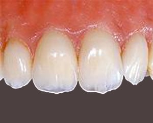 Close-up of four upper front teeth and the gumline.