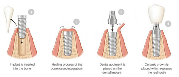Diagram of four phases of the dental implant process, 1) implant insertion, 2) healing process, 3) abutment placement, 4) crown placement.