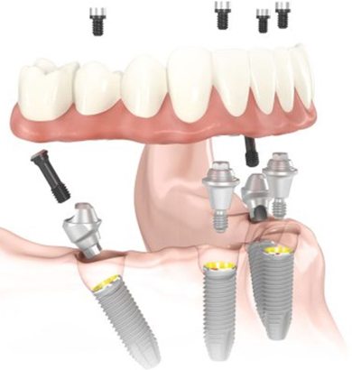 Image of a dentures being anchored to all on four dental implants