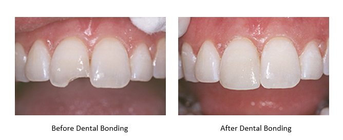 Before and after teeth bonding