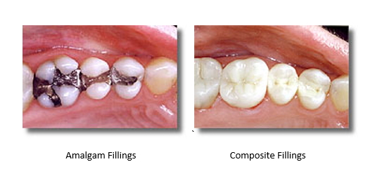 before and after silver amalgam fillings