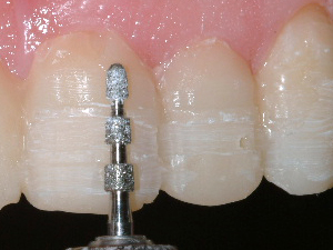 A tooth being prepared for porcelain veneers