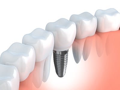 illustration of a dental implant