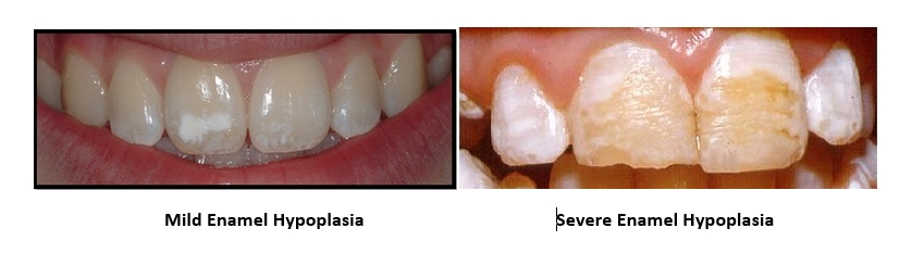 mild and severe enamel hypoplasia