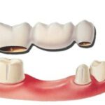 An illustration of a dental bridge.