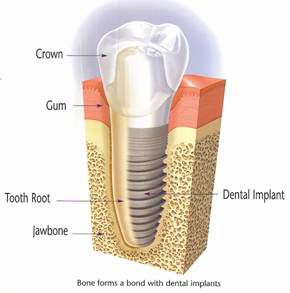 dental implant image