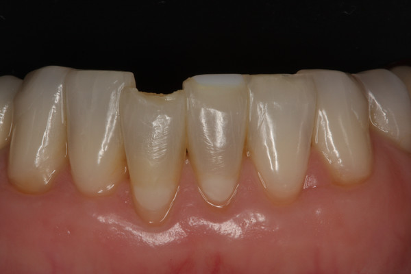 Anterior tooth chipped