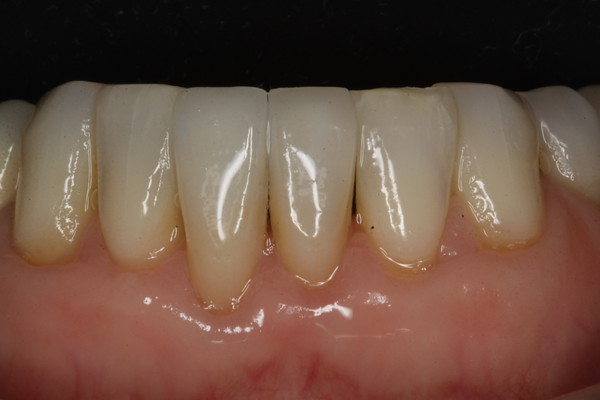 Repair on the anterior teeth