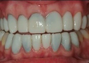 An example of leaky porcelain veneers.